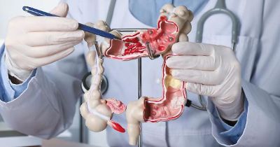 colon retto oncologia screeening